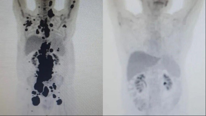 Imagem das tomografias feitas por Paulo Peregrino antes e depois do tratamento: as áreas escuras indicam a presença do câncer